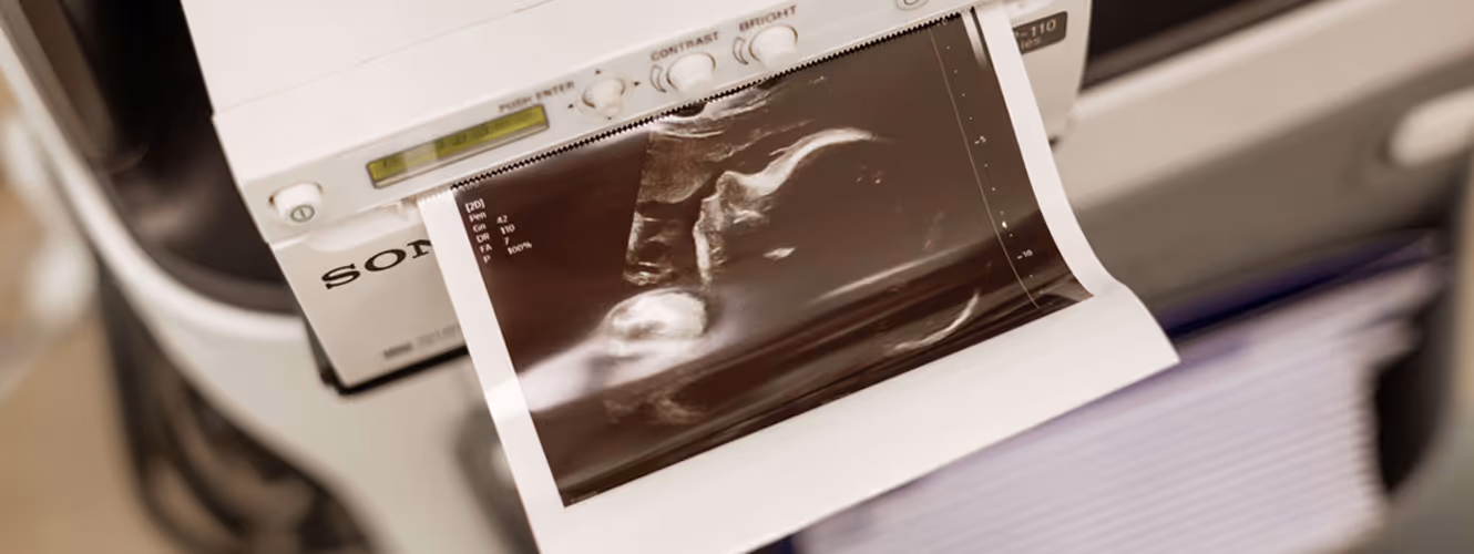 Echobeeld van een ongeboren baby die wordt geprint door een medische printer.