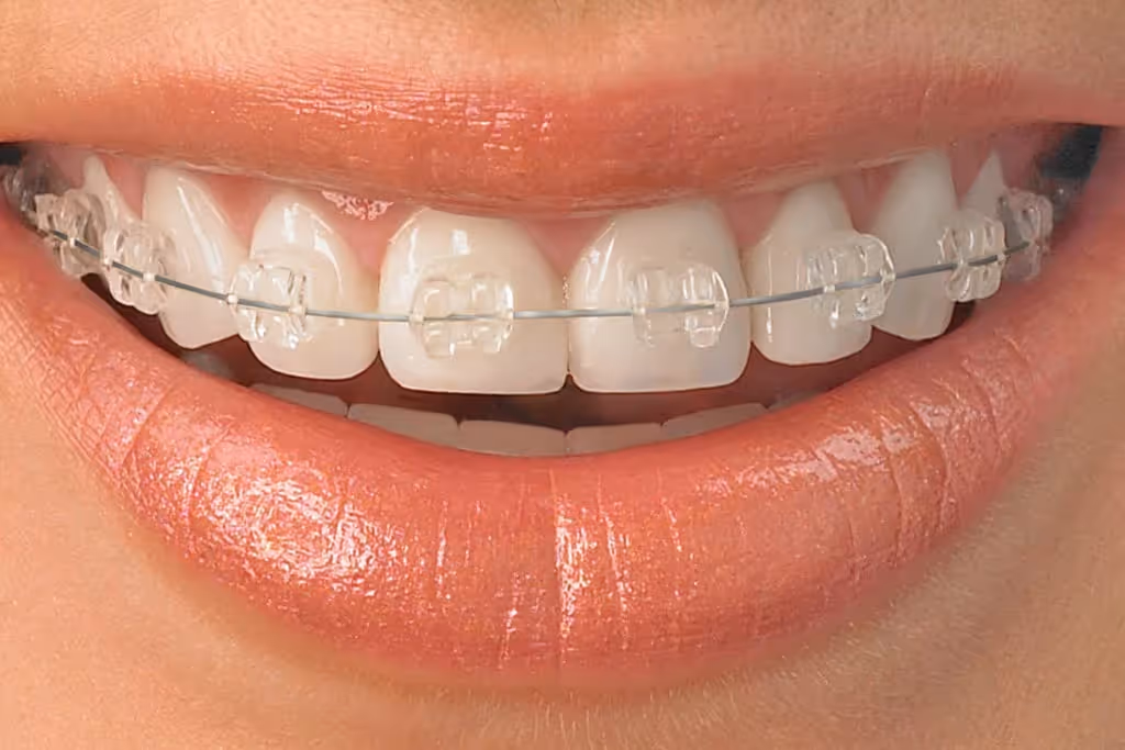 Close-up of a smiling mouth with clear ceramic braces on upper teeth and glossy lips.