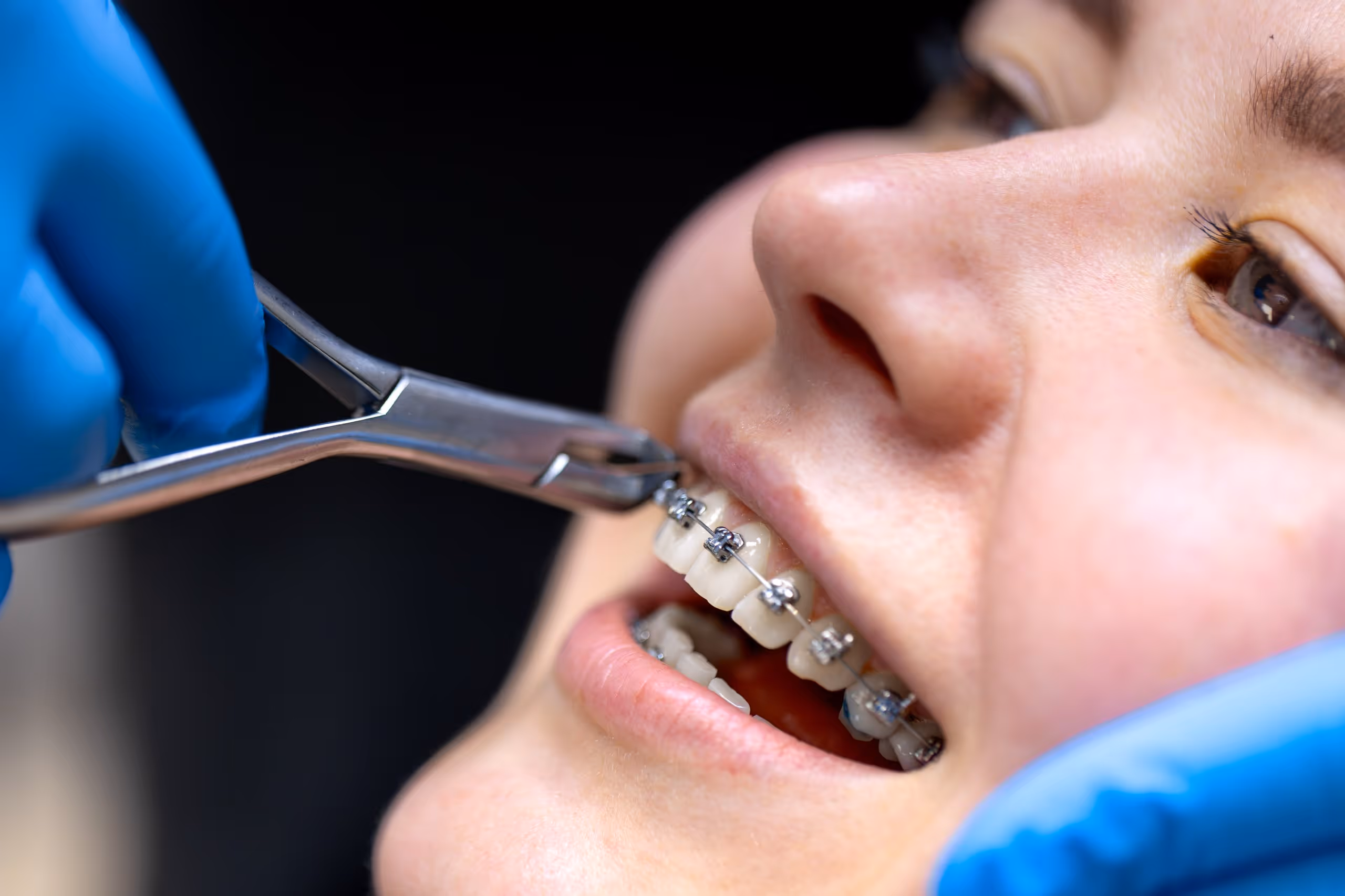 Close-up of a dentist with blue gloves adjusting braces on a smiling patient's teeth with dental pliers.