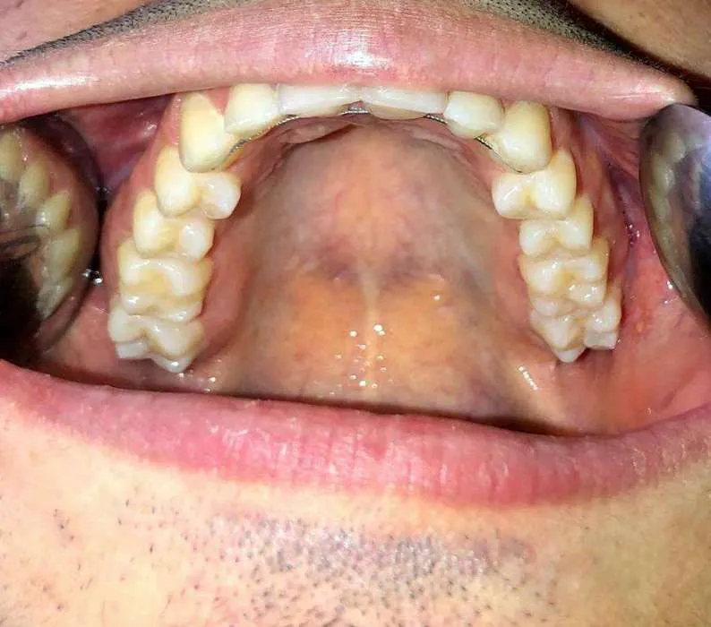 Close-up of an open mouth showing the upper teeth from the inside along with dental retractors on the sides.