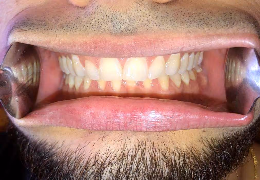 Close-up of a person's mouth with cheeks held open by dental retractors, showing healthy upper and lower teeth and gums.