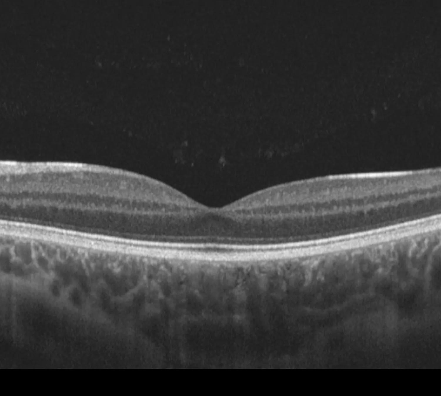 OCT optical coherence tomography scan displaying retinal layers for macular degeneration and glaucoma diagnosis