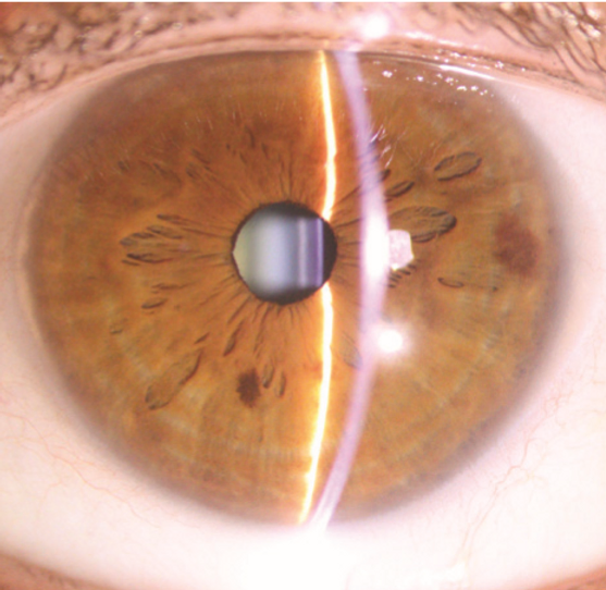 Eye Treatment Image - Before