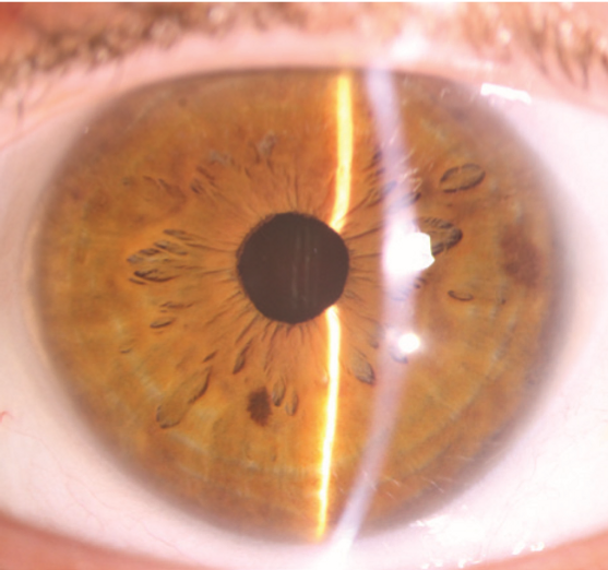 Eye Treatment Image - After