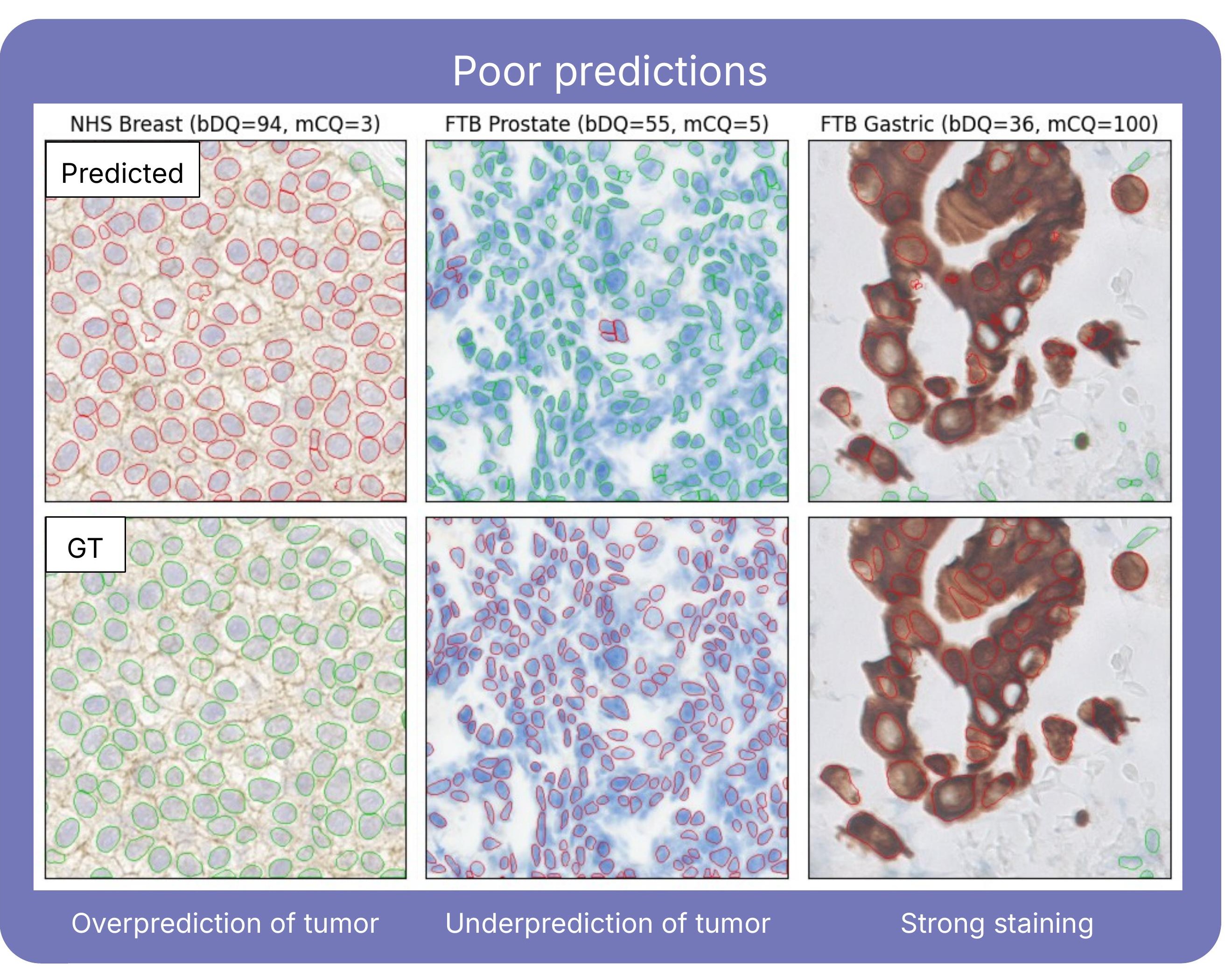 IHC tiles comparing AI cell predictions (top) with pathologist ground truth (bottom): breast HER2 over-predicted as tumor, prostate under-predicted as tumor, and strongly stained gastric cells hard to detect.