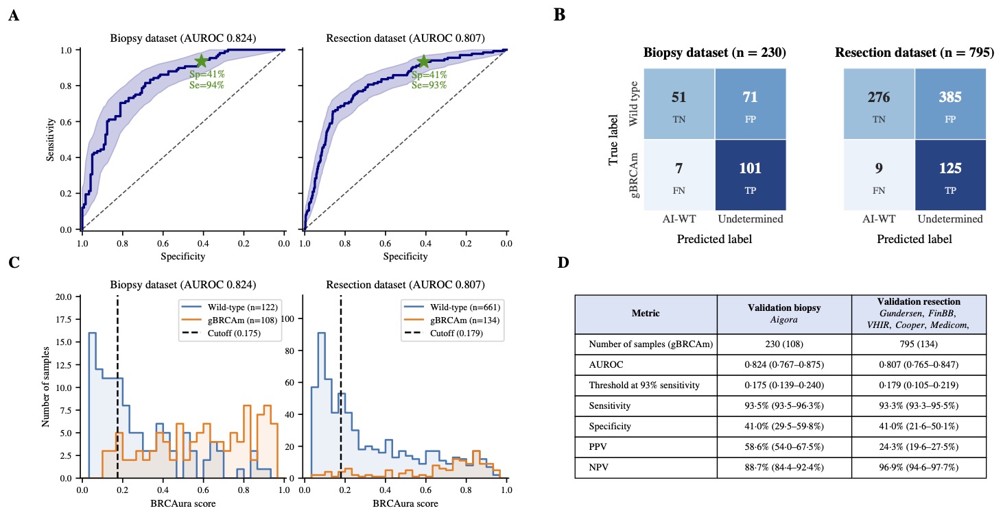 ROC curves, confusion matrices, and score distributions showing BRCAura performance in 230 biopsies (AUROC 0.824) and 795 surgical resections (AUROC 0.807), with sensitivity of at least 93%.