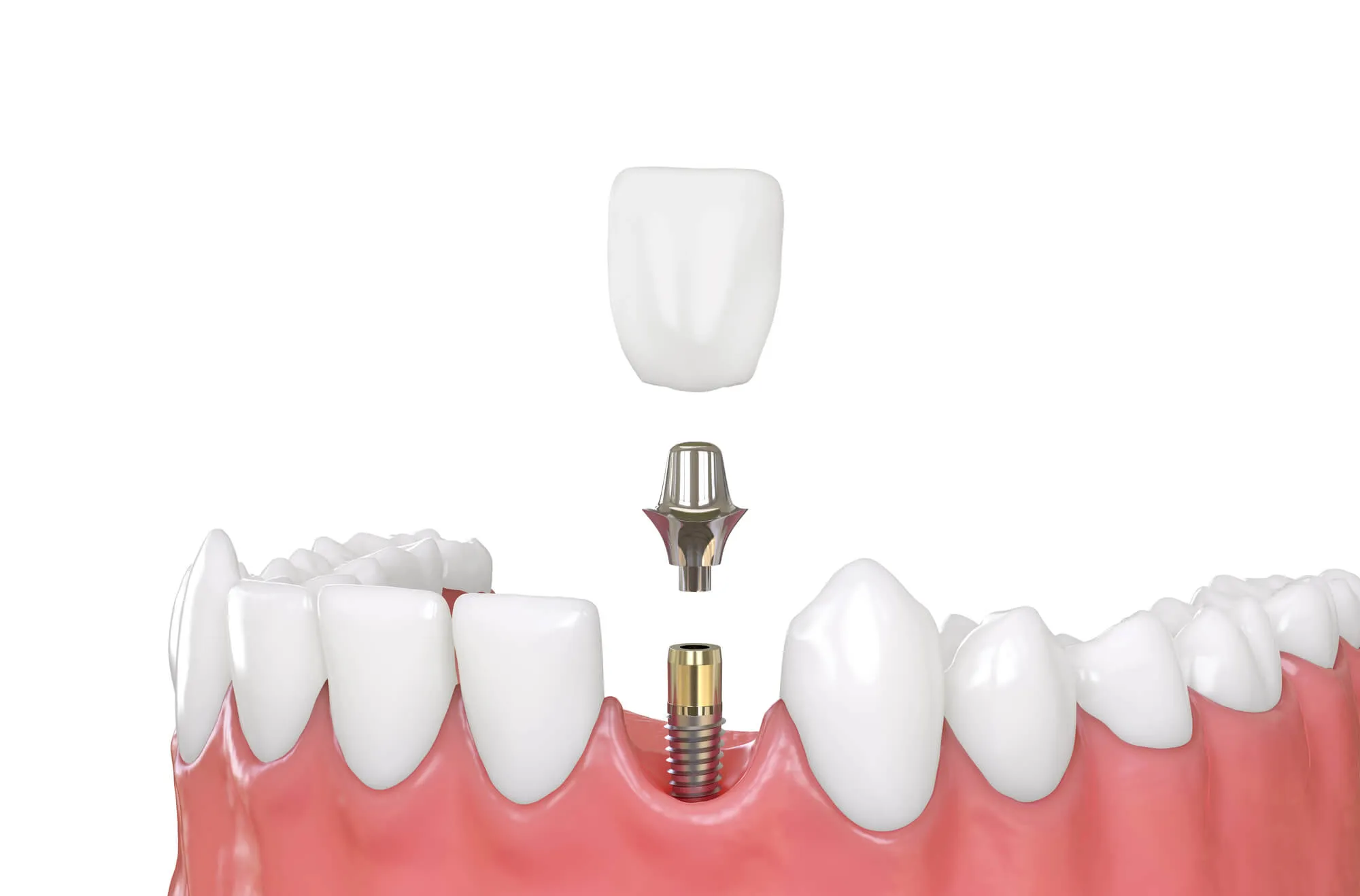 dental implants in blue bell illustration
