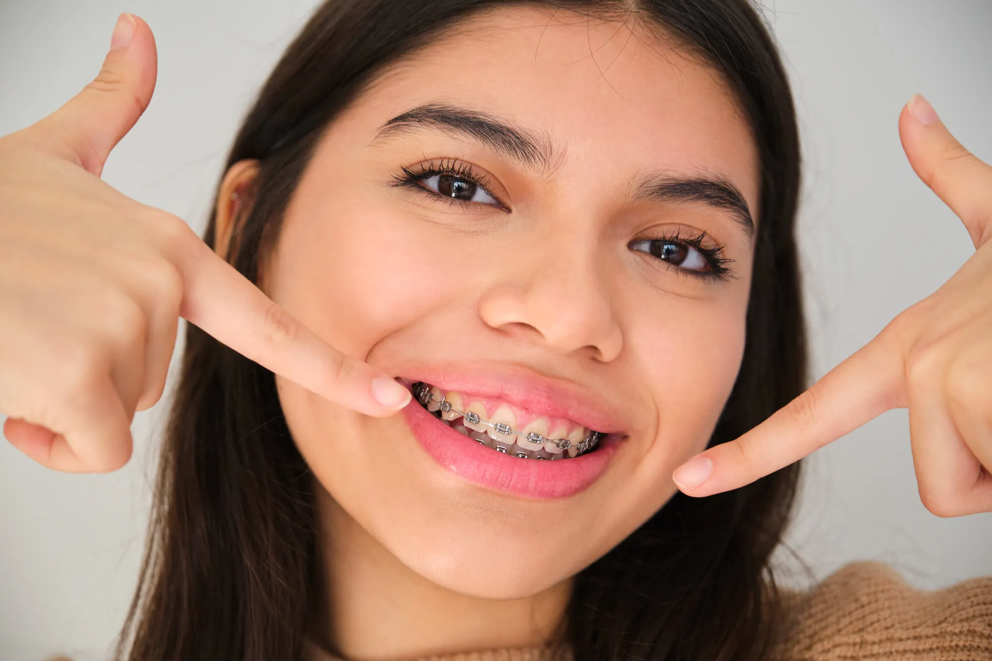 patient opted for braces instead of invisalign in blue bell