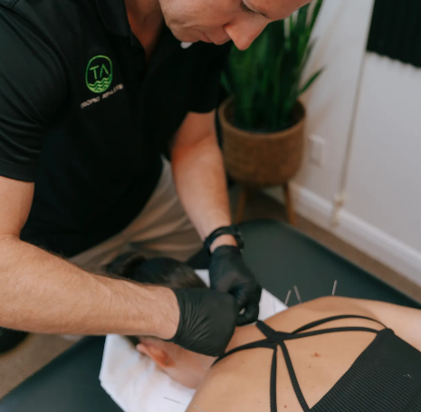 dry needling at Tropic Athlete