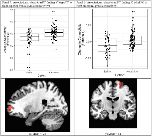 findings ketamine saline treatment