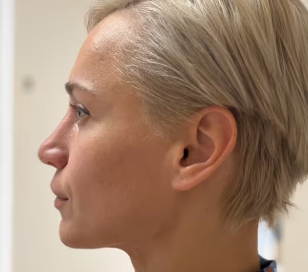 After facial massage side profile with sculpted appearance