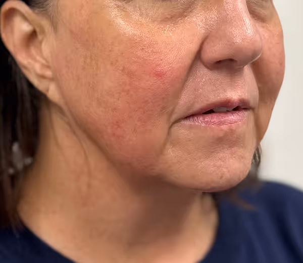 After facial massage side profile with sculpted appearance