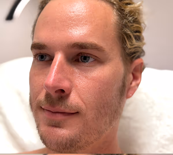 Before facial massage side profile