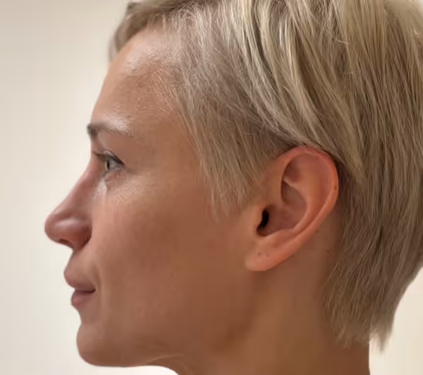 Before facial massage side profile