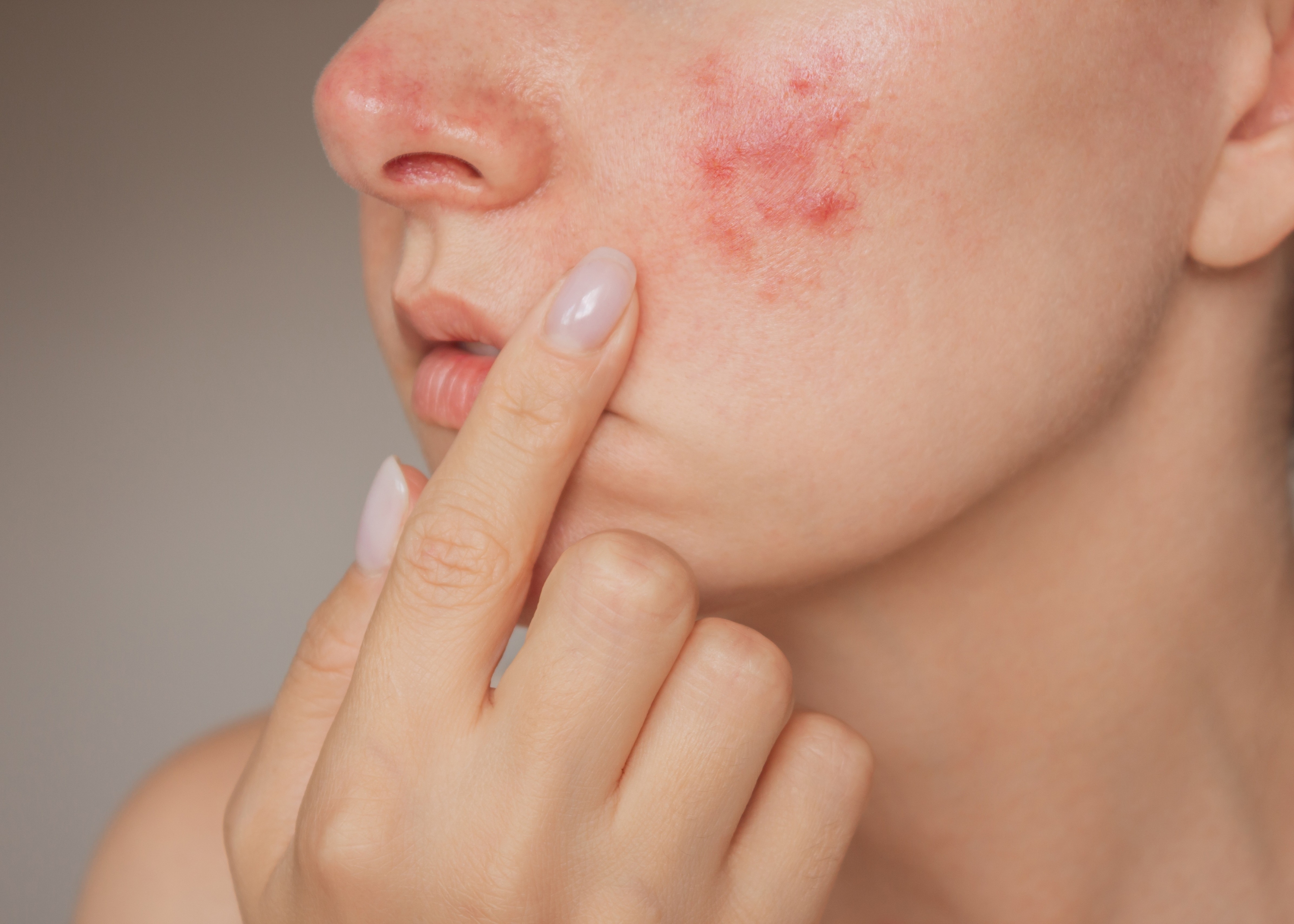 Rosacea