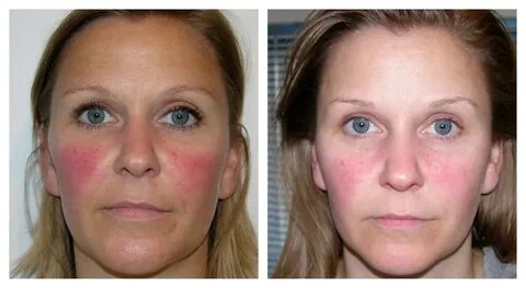 Rosacea
