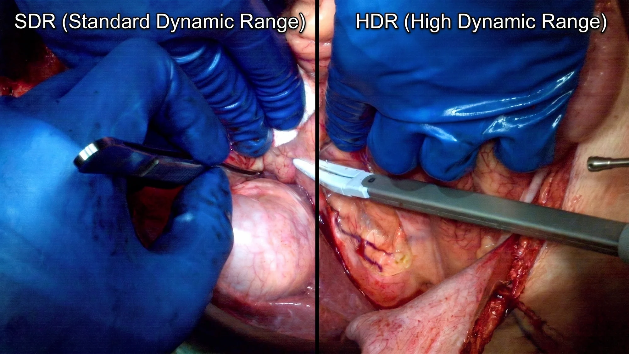 Split-frame comparison of the same surgical field: on the left in standard dynamic range the cavity is crushed to black and the lit tissue blows out; on the right in 4K HDR both the shadowed and brightly lit areas hold detail.
