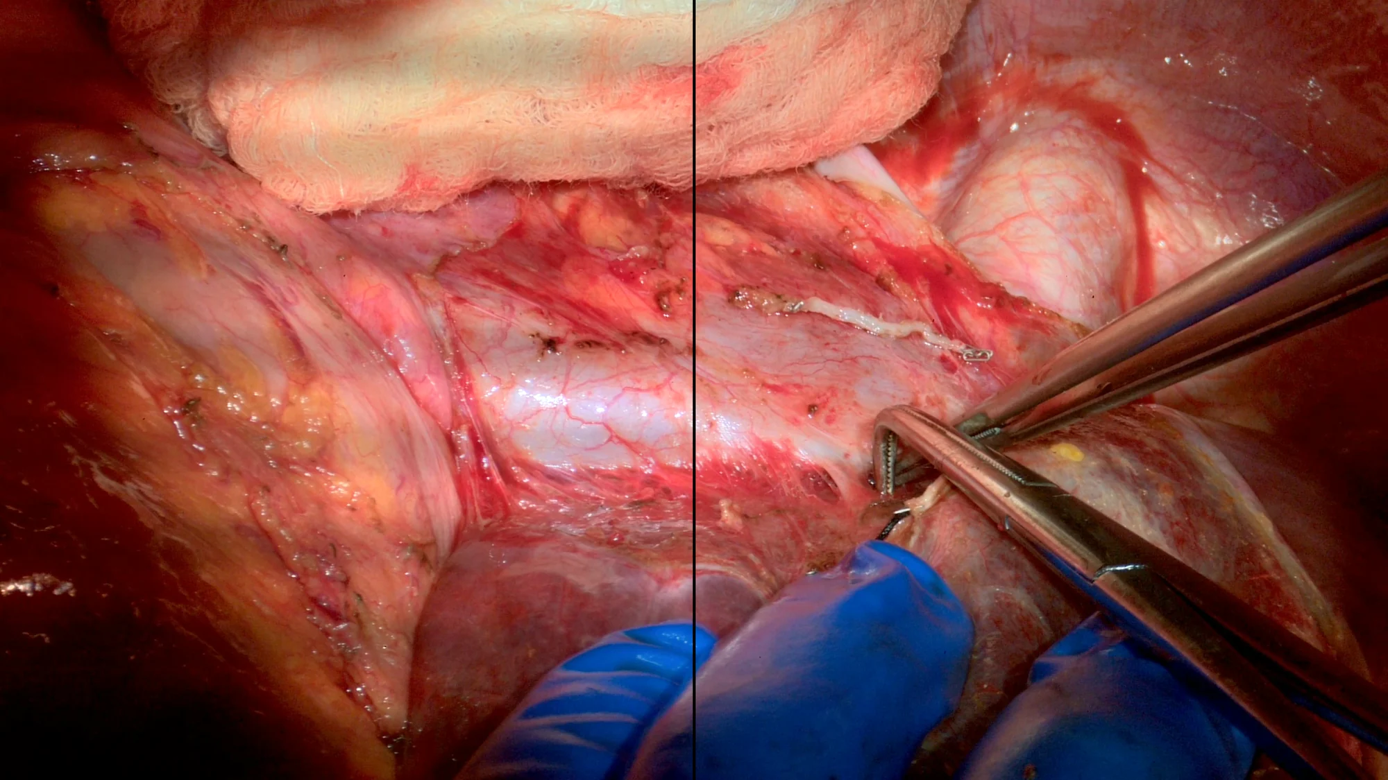 A single surgical frame split down the middle by a vertical divider, showing the same field under two different camera processing settings.