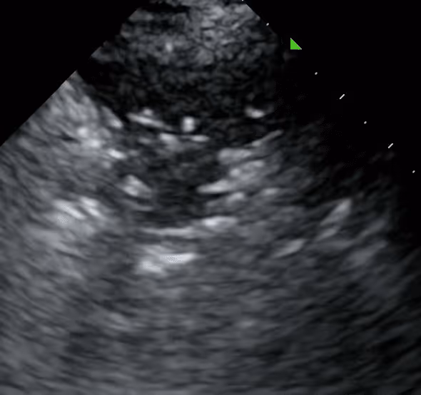 Shred sign seen at the border between normal and abnormal lung