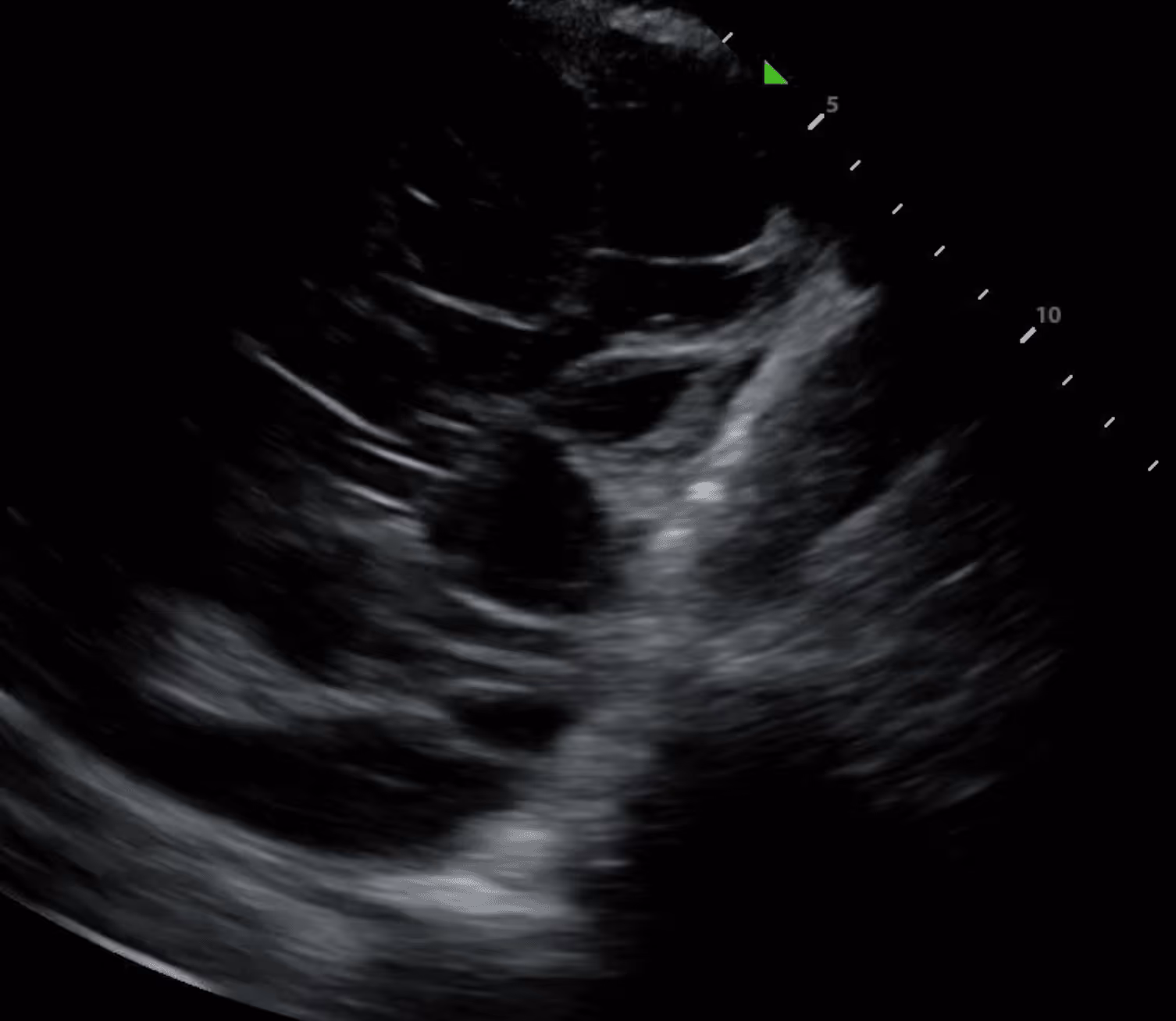 Septated pleural effusion