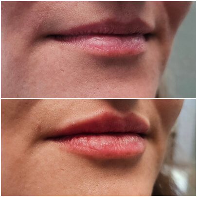 Side-by-side close-up of a patient’s lips showing before and after results, with the after image revealing fuller, more defined, and hydrated lips, demonstrating the effects of a personalized aesthetic treatment.