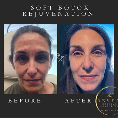 Side-by-side before and after images of a woman showing the effects of soft Botox rejuvenation, with smoother skin, reduced wrinkles, and a more refreshed appearance in the after photo.