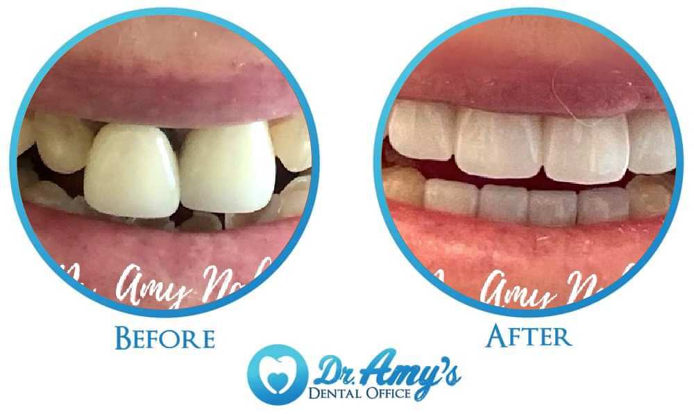 Before and after restorative dental treatment