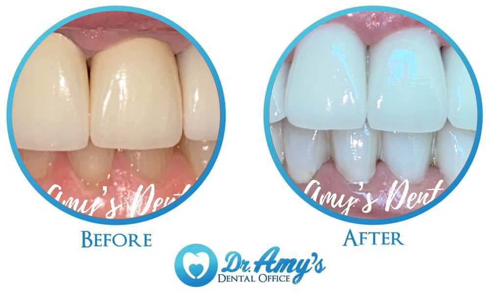 Full smile rehabilitation results