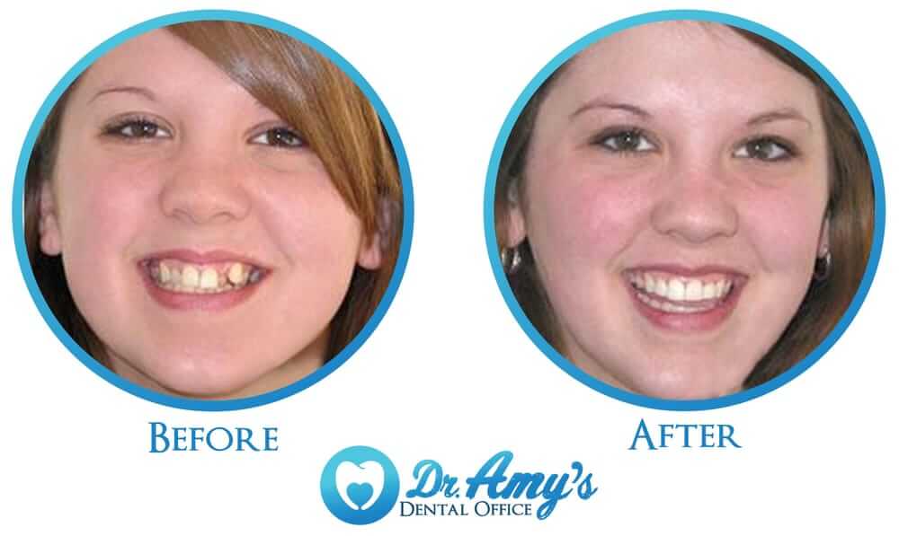 Restored smile after dental implant treatment