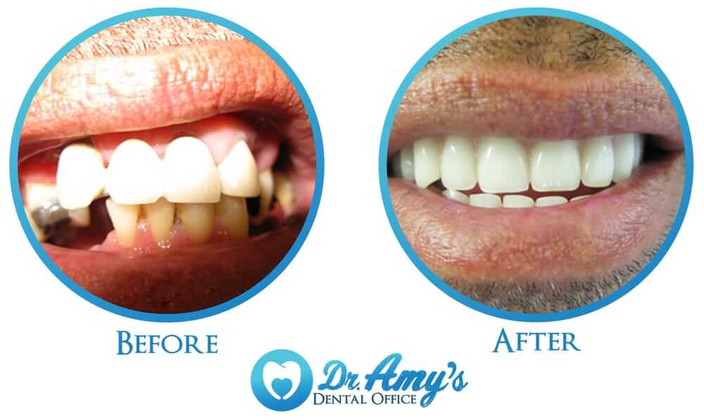 Improved tooth alignment and aesthetics