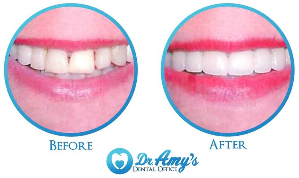 Straighter and brighter smile transformation