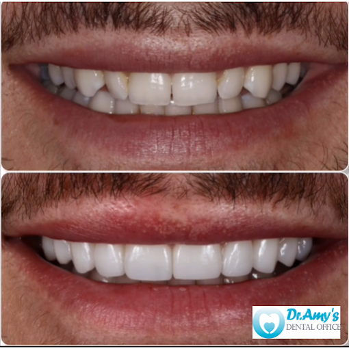 Before and after smile transformation