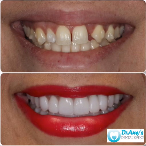 Natural-looking smile restoration