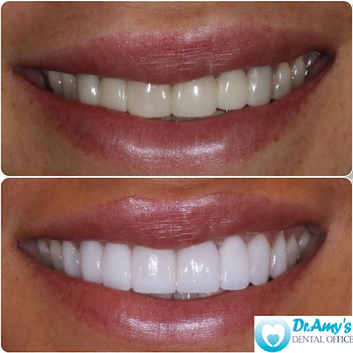 Before and after teeth whitening