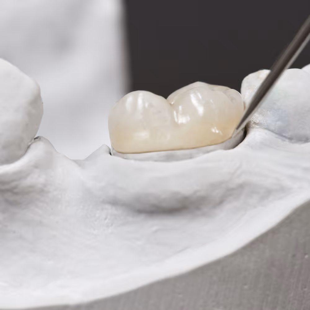 Metal-free crown restoration procedure