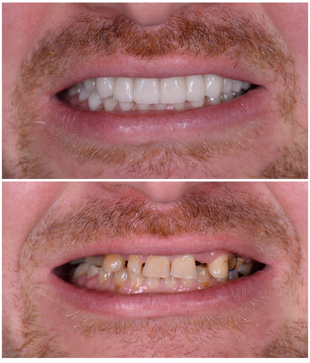 Natural-looking result after dental crown placement