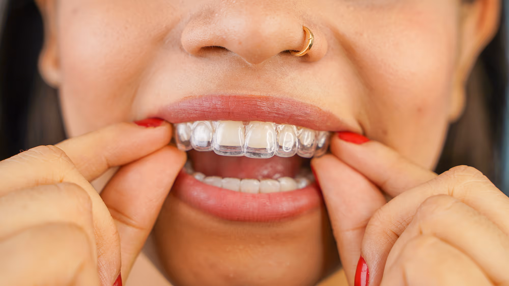 Before and after Invisalign® treatment