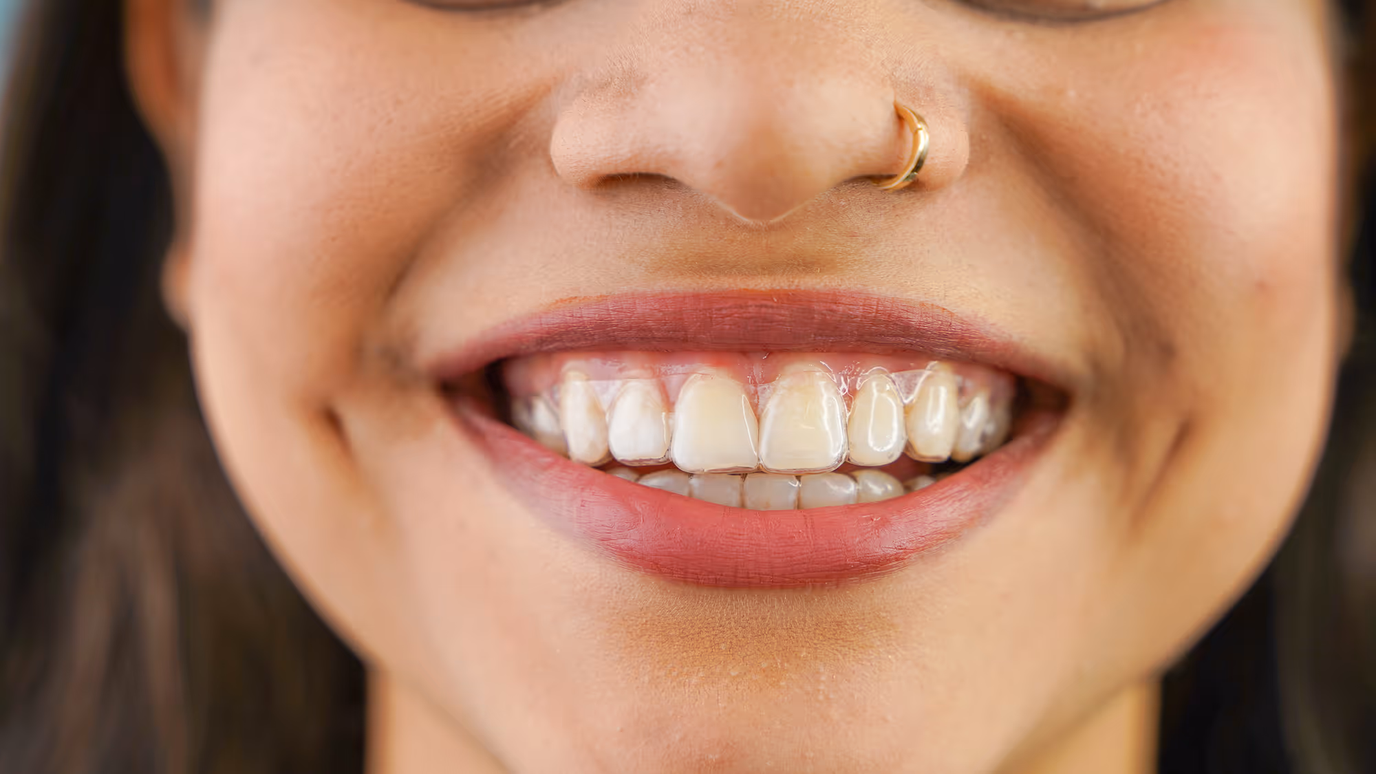 Straighter smile after Invisalign® treatment