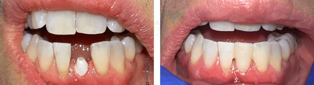 Before and after metal-free zirconia implant
