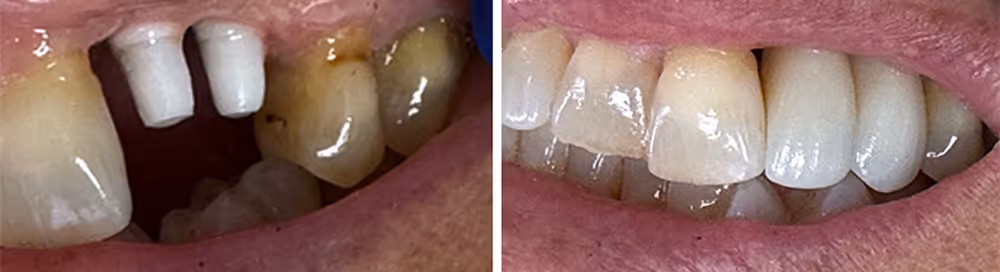Natural-looking result after zirconia implant placement