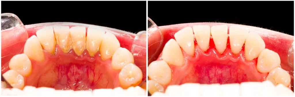 Before and after periodontal therapy results