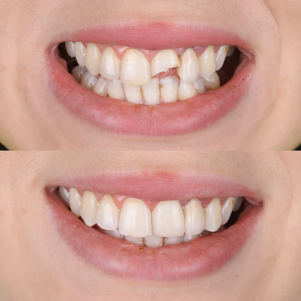 Before and after biocompatible dental filling