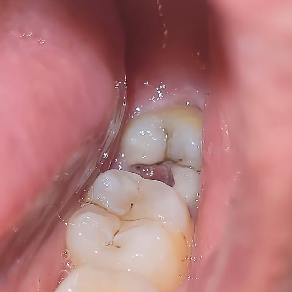 Before and after atraumatic tooth extraction