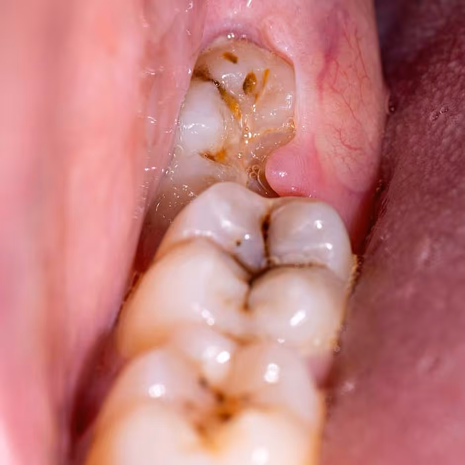 Healing results after atraumatic tooth extraction