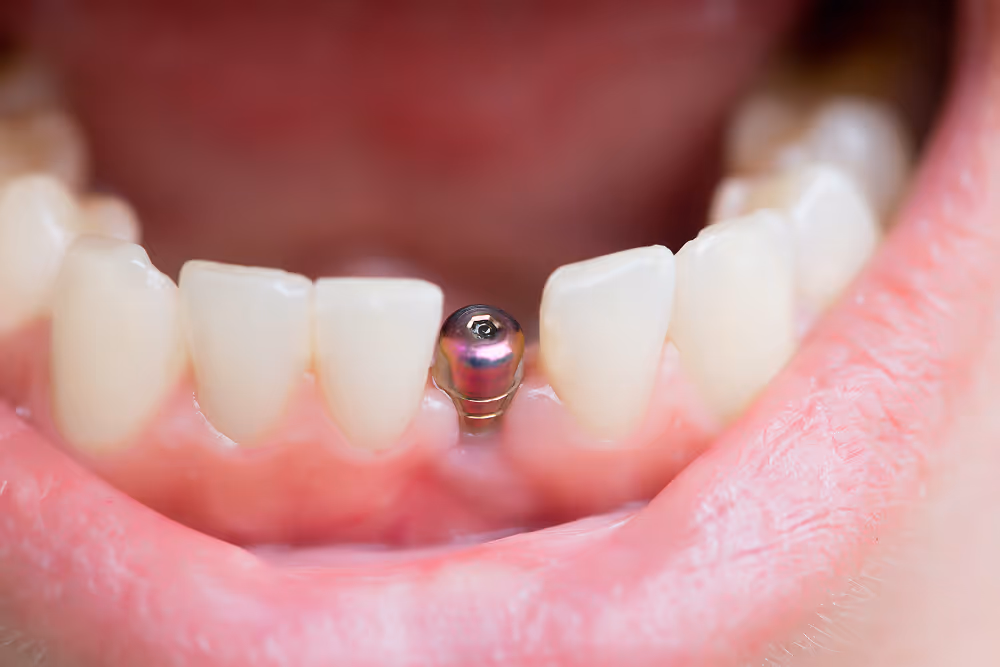 Smile improvement after single dental implant