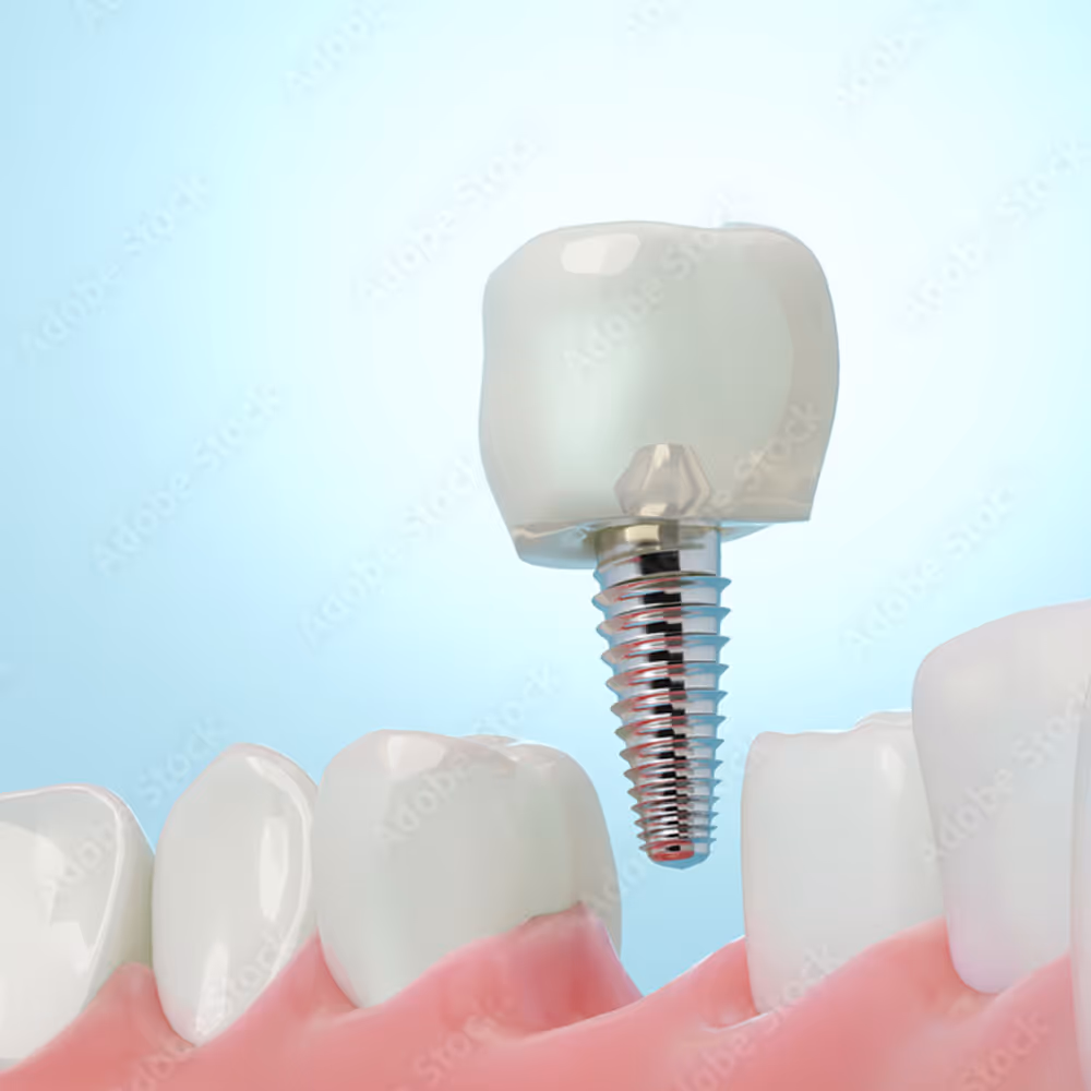 Single dental implant structure and components