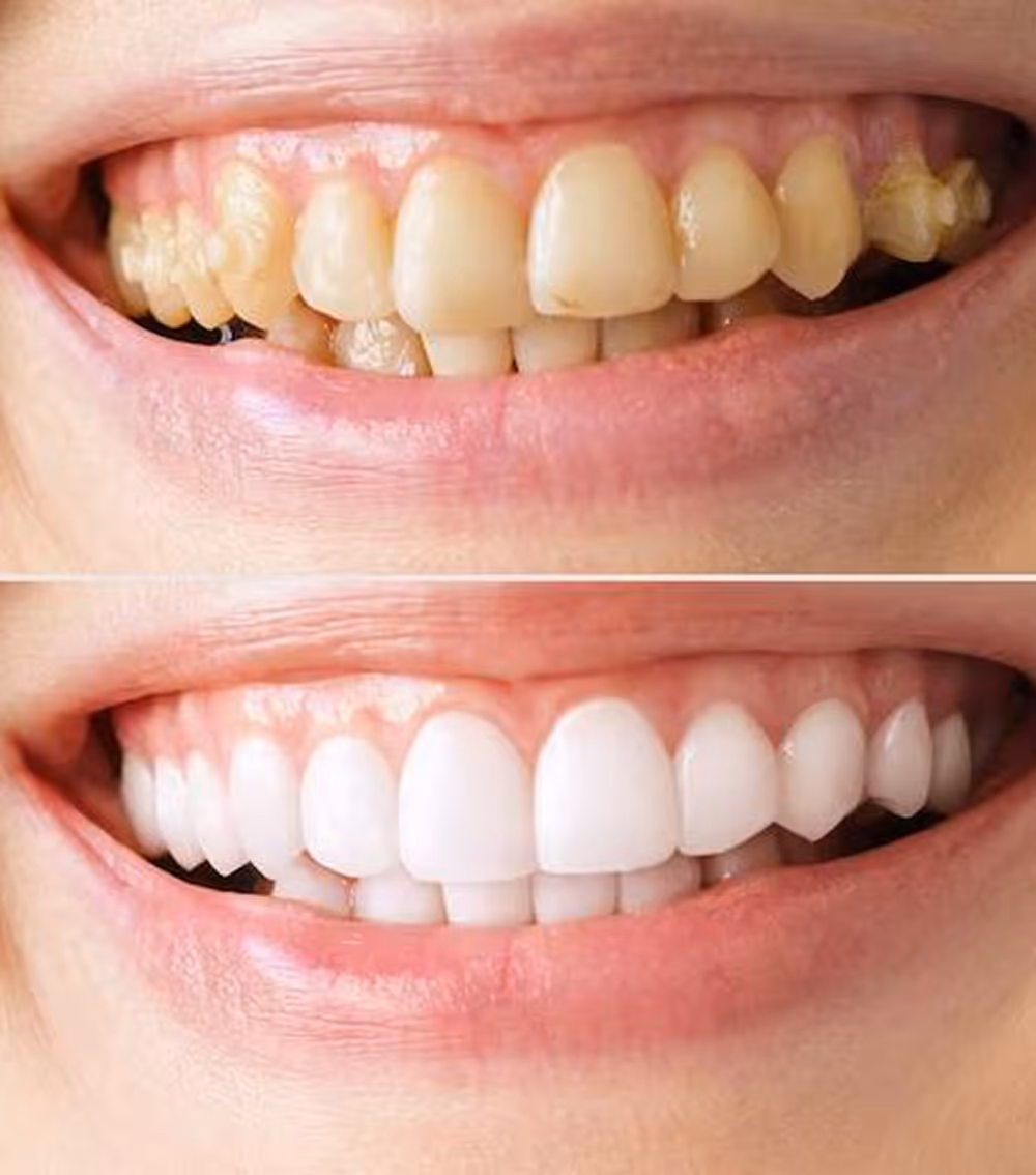 Restored function and aesthetics after full mouth reconstruction