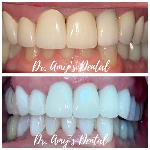 Before and after ZOOM! teeth whitening