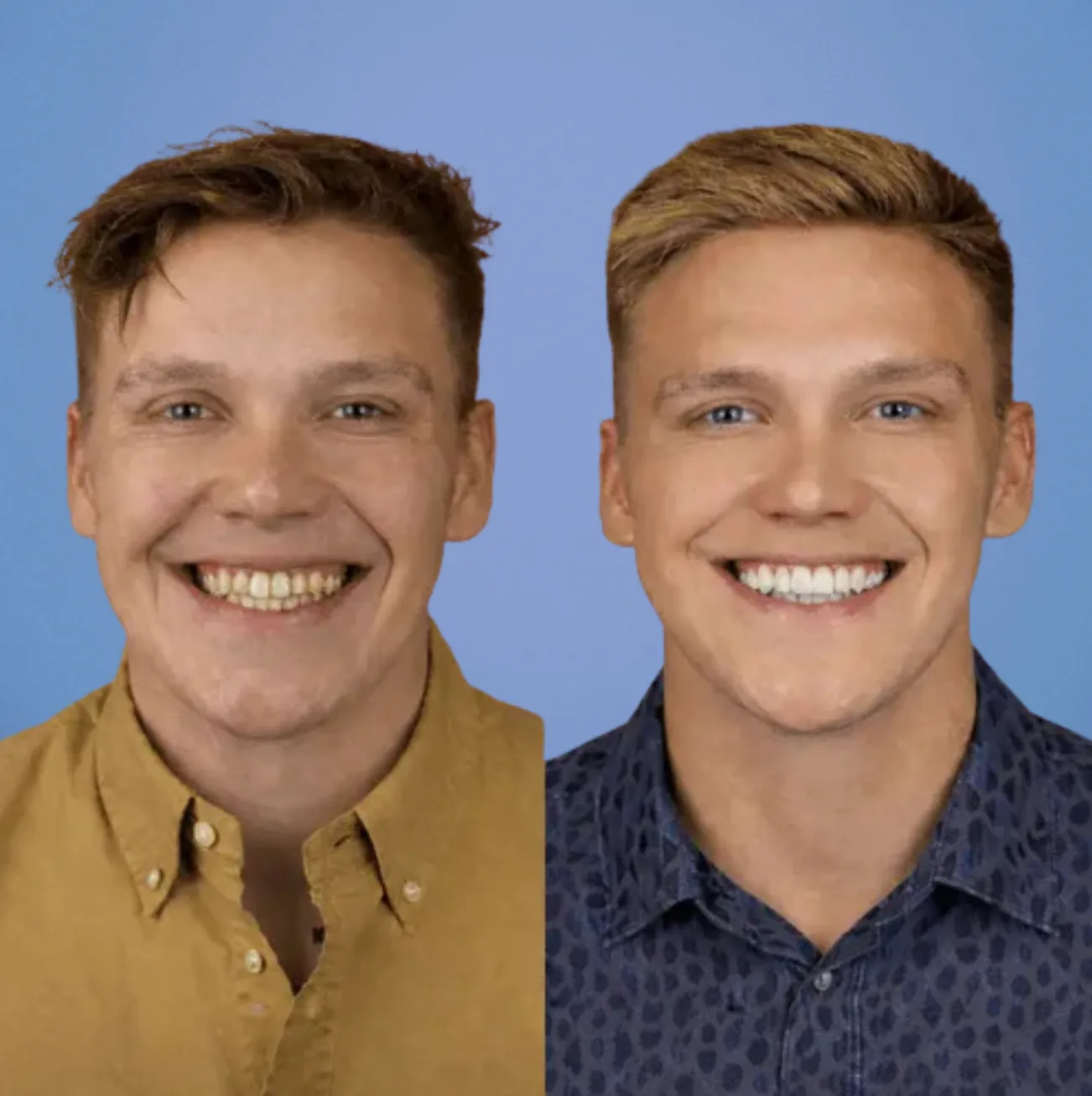 Dr. Amy's Patient Transformation: 12 Upper Porcelain Veneers + Zoom! Whitening