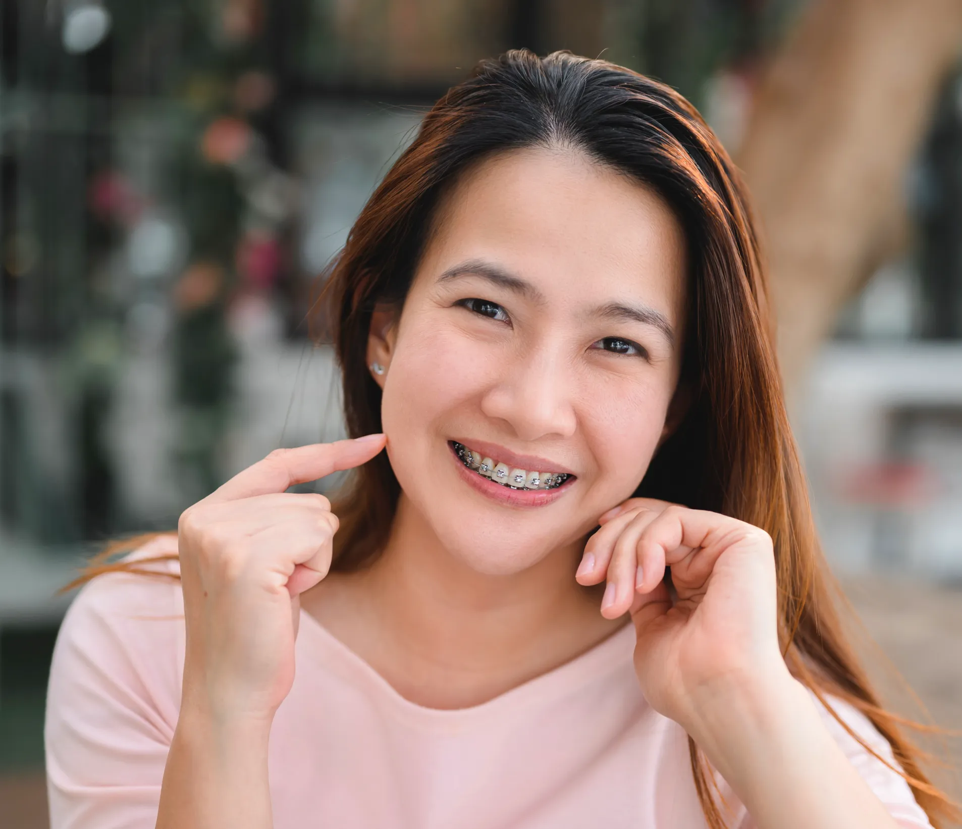 Braces in Barrie, ON